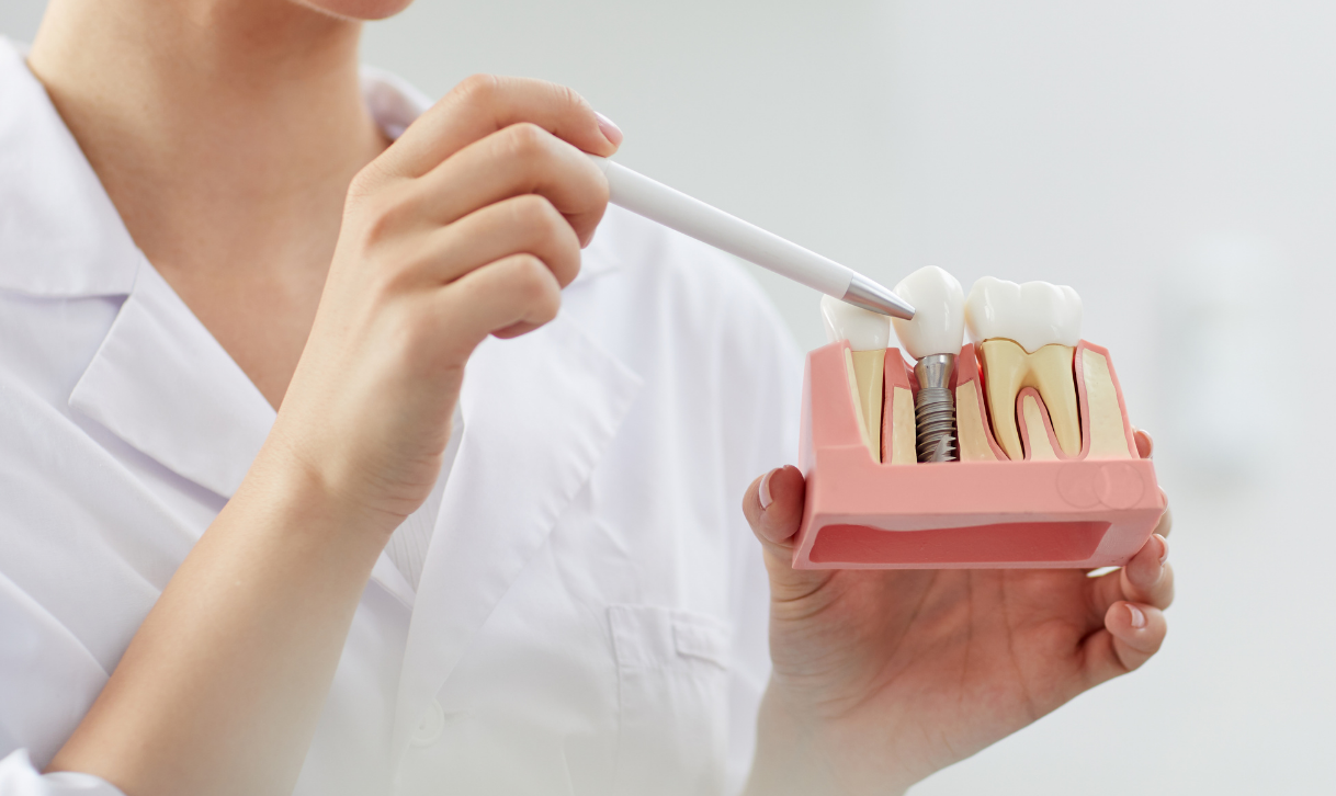 Implante Dentário
